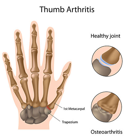 osteoarthritis first metacarpophalangeal joint)